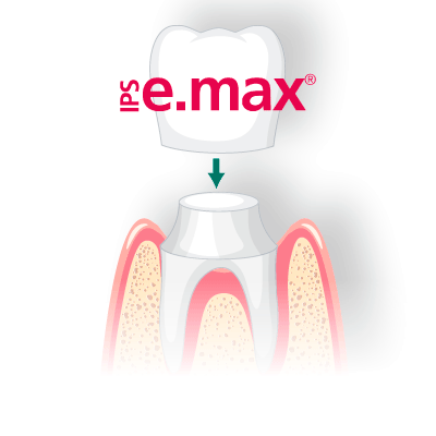 Коронки E-max